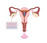 התקן תוך רחמי לצעירות-תמונה